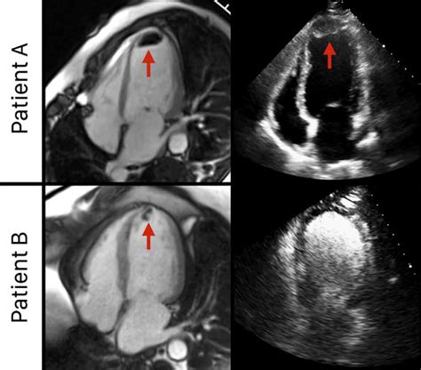 lv thrombus in echo|left ventricular thrombus after heart attack.